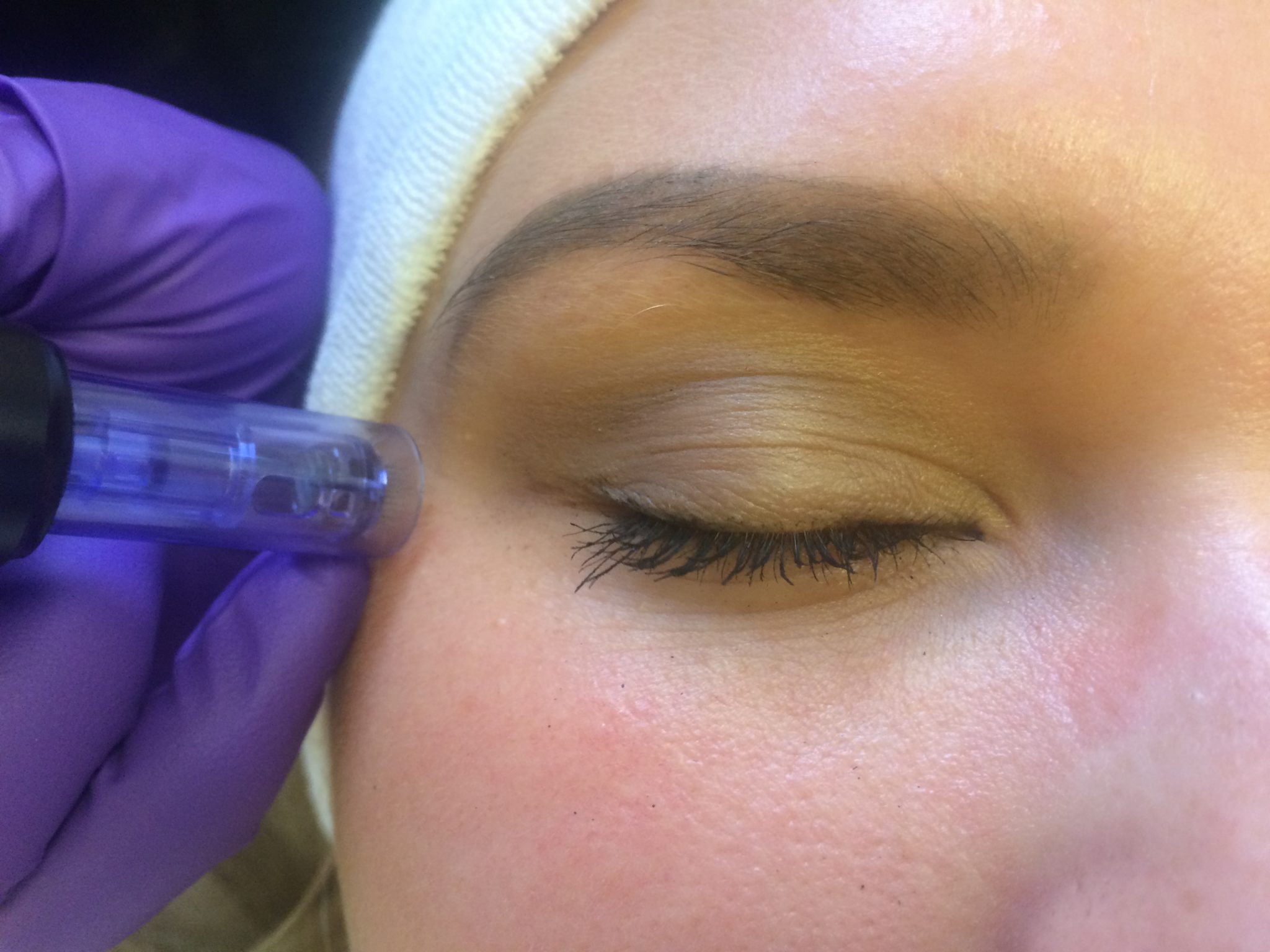 dermapen rita kuiper